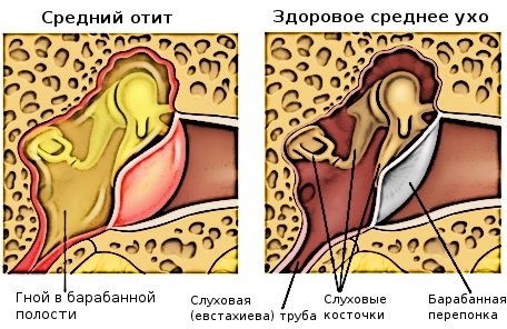 Лечение боли в ушах при простуде в Москве в клинике Столица