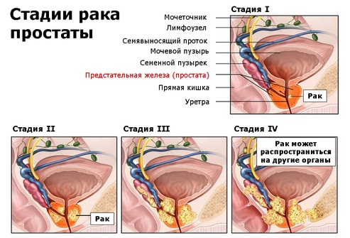 Простатит и импотенция